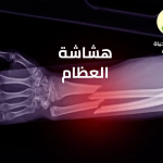 هشاشة العظام